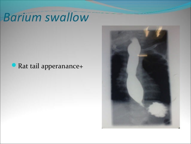 Smoking Essay Topics Achalasia Barium Swallow